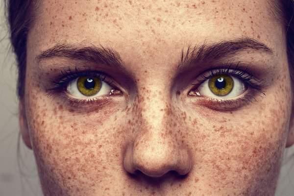Freckles on Face: Natural Home Remedies for Freckles  Don’t Let Freckles Remove Your Beauty.
