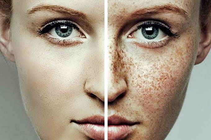 Freckles On Face Natural Home Remedies For Freckles Dont Let Freckle